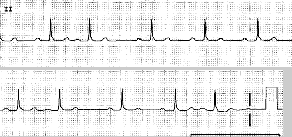 Image of EKG strip