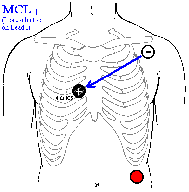 Drawing of torso showing lead placement locations