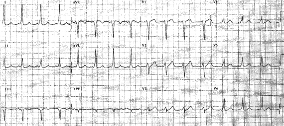 Wolf Parkinson White EKG strip