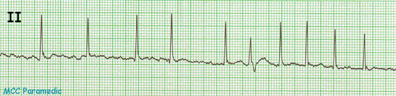 Image of ekg strip