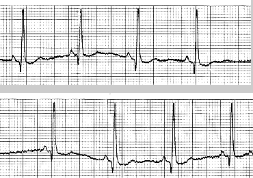 Image of ekg strip