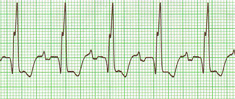 ekg