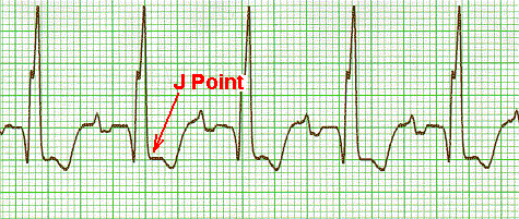 ekg