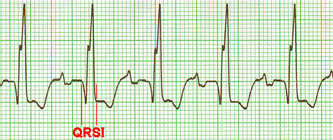 ekg