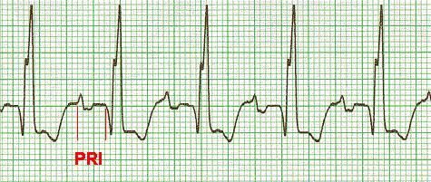 ekg