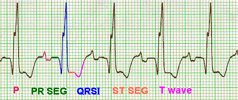 ekg