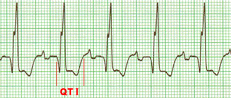 ekg