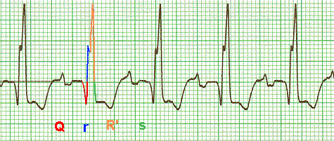 ekg