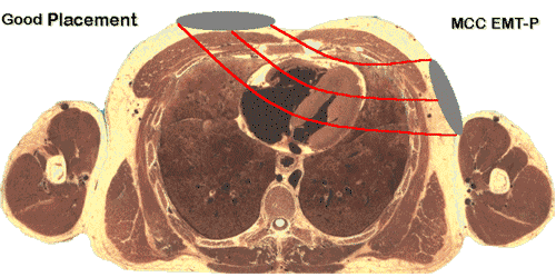 cross section of heart during defibrillation