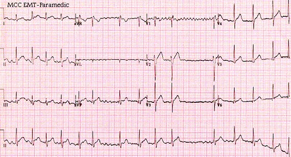 Image of ekg