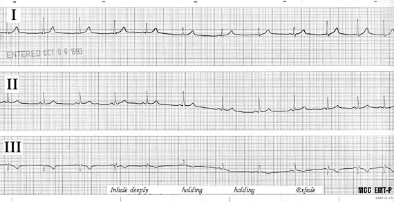 ekg strip