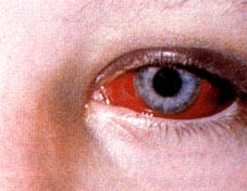 Photo of red eye hemorrhage