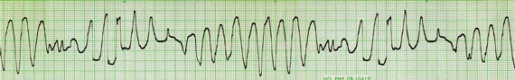 Image of ekg strip