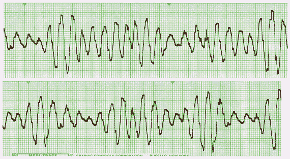 Image of ekg strip