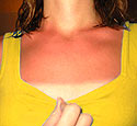 sunburned girl